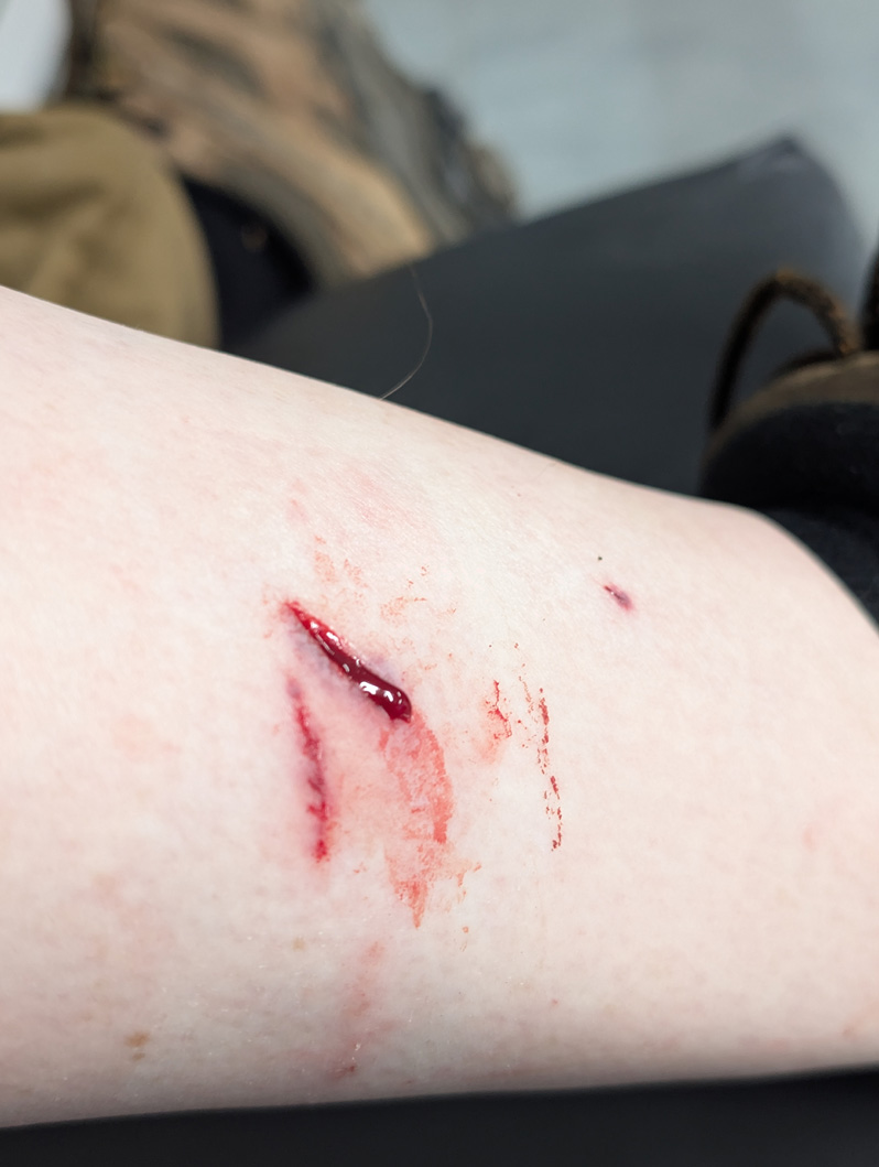 Nauru: Dog Bite